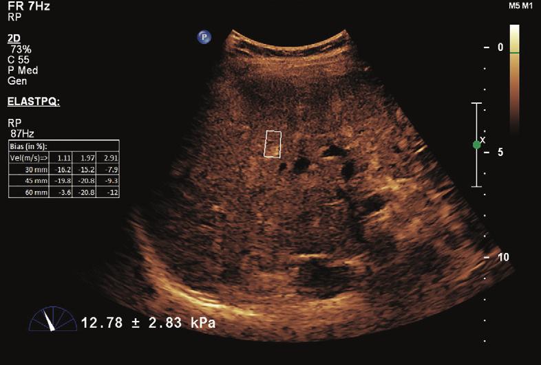 The patient s hepatitis C infection was of genotype 1a, which often proves resistant to these medications. In 2011, the patient was examined with CEUS and B-mode ultrasound.