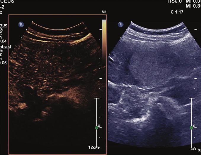 In addition to typical cirrhotic changes, ultrasound showed a new hyperechoic mass.