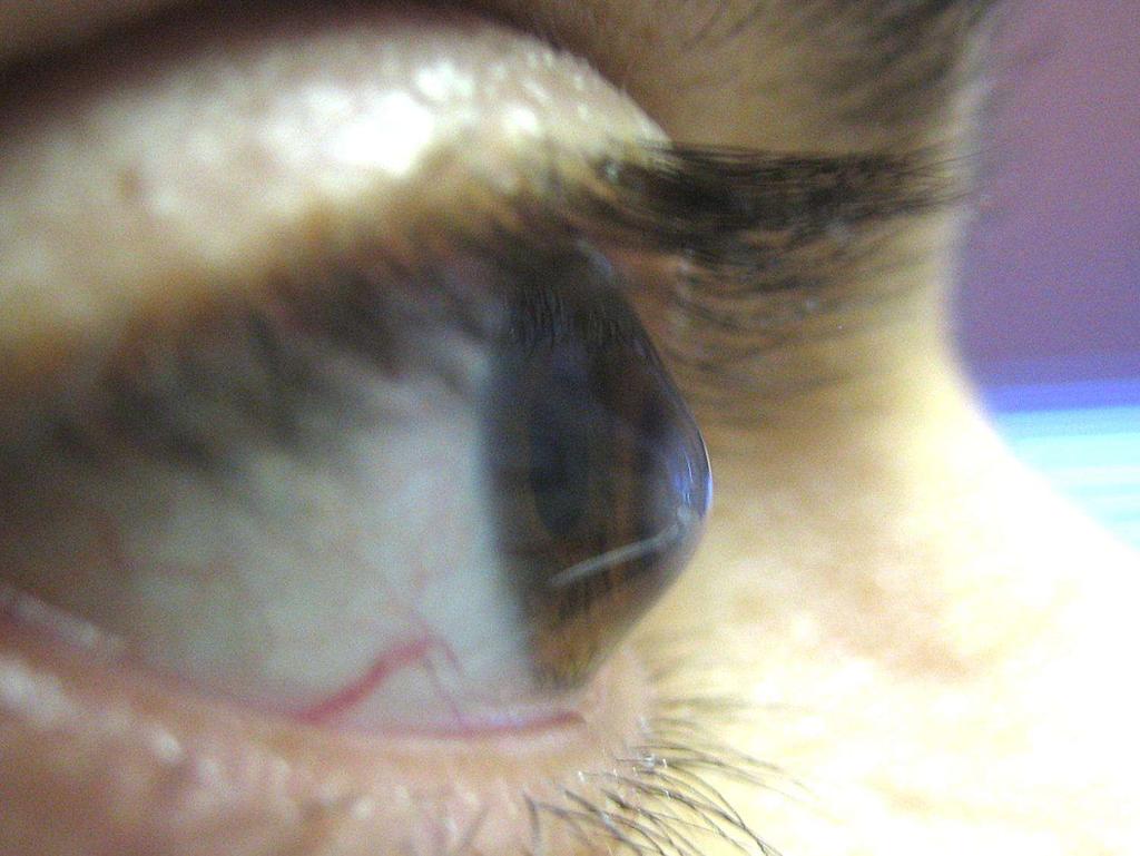 Do NOT touch the cornea during phaco Consider scleral tunnel phaco incision