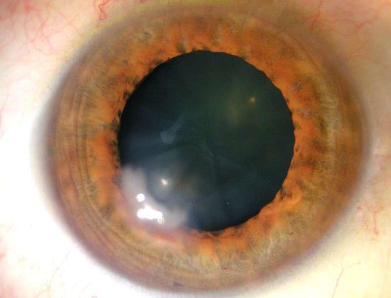 Epithelial Ingrowth after LASIK poor vision: 90% ingrowth + 10%