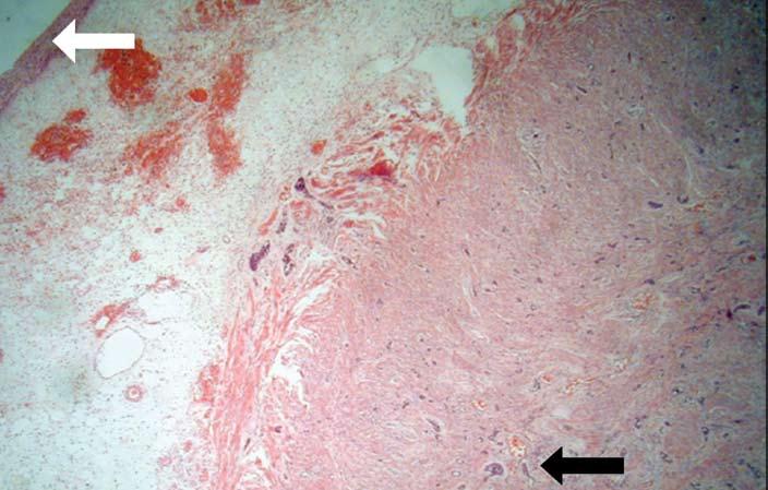Goblet Cell Carcinoids of the Appendix 41 Fig 1.