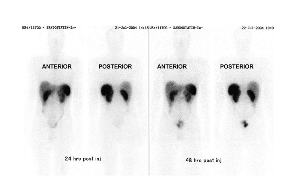42 The Ulster Medical Journal Fig 3. The normal octreotide scan of the patient looking for evidence of metastatic disease.