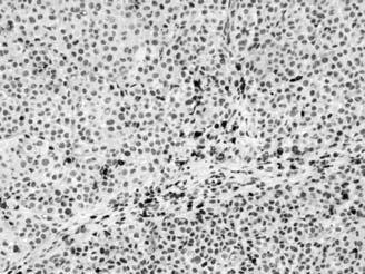 Patterns of expression in melanoma Sci TranslMed. 2012 Mar 28;4(127):127ra37.