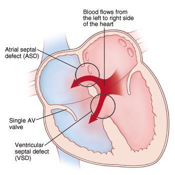 Ventricular Septal Defects (VSD) rank first on all lists of cardiac defects membranous part of the IVS common site of VSDs What happens?