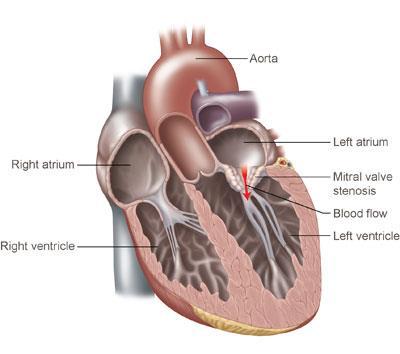 Narrowing of the mitral orifice.