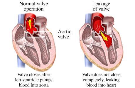 During diastole blood regurgitates from aorta back to the