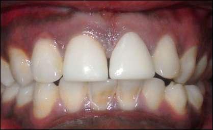 fig 4: Post-operative Photograph III. Discussion Ceramic veneers have been shown to be a good conservative and aesthetic treatment option.