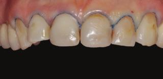There are three methods to reduce the vestibular enamel: Figure 3: Diagnostic wax-up. Figure 5: Gingival retraction cord in-situ, #1 cord (Ultrapak, Ultradent). 1. Freehand; 2.