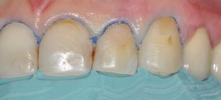 Figure 6: PVS reduction index in use on the right side. 0.4 mm. This allows the veneer to avoid an overcontour.