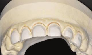 Figure 10: Temporaries in situ. Temp-Bond Clear Dental) was used. (Kerr 2.7.