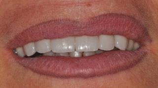 the veneers (Figures 11-13), the tooth surface should be cleaned of any residual resin cement or provisional material, to ensure