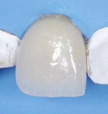 Restorations are removed, dried and silane primer is applied to the fitting surface, which helps provide a chemical covalent bond to the ceramic.