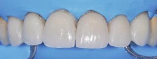 26 Global Journal of Oral Science, 2016, Vol. 2 Mancini and Mancini However sometimes a fine diamond bur can be used to adjust the porcelain that will be then carefully polished.