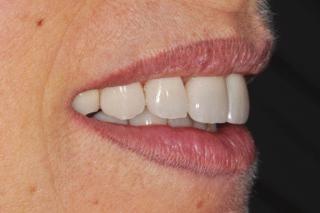 CONCLUSION Based on the clinical findings of the present case report, it can be concluded that the reproduction of the lifelike aesthetic appearance of natural teeth and the Figure 24: Pre-op and