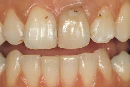 TOOTH Preparation with Clear Intent The first requirement to establish the final esthetic and functional outcome is to determine the definitive incisal edge position and the amount of translucency