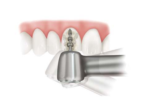 USE OF Burs - Facial Reduction The choice of depth cut and bur selection depends on: The masking required to make the shade/value change and incorporate the translucency expected in the outcome The