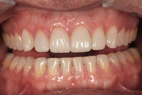 If you are adding length or facial volume, you can preserve tooth structure by making a mock-up based on the diagnostic wax-up, and performing depth cuts directly there.