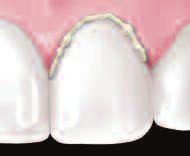 Tack the veneer in place by briefly light curing the gingival