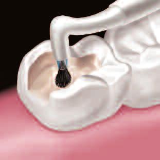 Once stabilized, light cure all marginal areas for 20 seconds from the buccal, lingual and occlusal aspects.