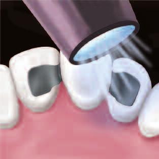 Maryland Bridges 3. Apply generous amounts of Prime & Bond NT Dual Cure mixture to thoroughly wet the tooth surfaces.