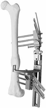 THE ACUTE CORRECTION TEMPLATES With the rail and templates thus held in a fixed relation to the limb, screws are inserted in the remaining seats of each template clamp (1 and 5 seats in children and
