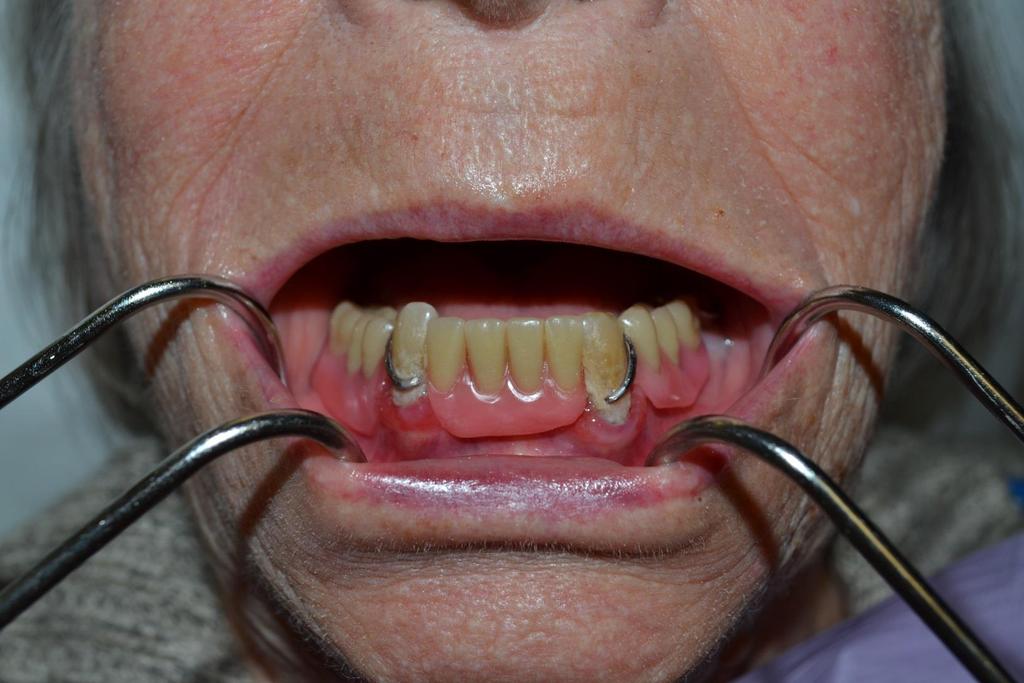 Lower Partial Denture with