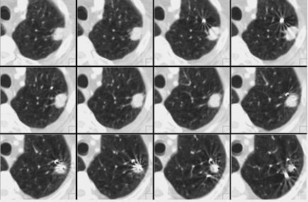 NSCLC Left Upper Lung * RESULTS: Radiographic complete response in 15