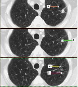 A follow-up PET/CT scan at ten months post treatment was negative at