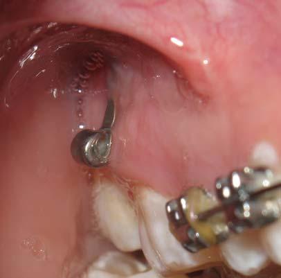 Posterior dental intrusion with a mandibular