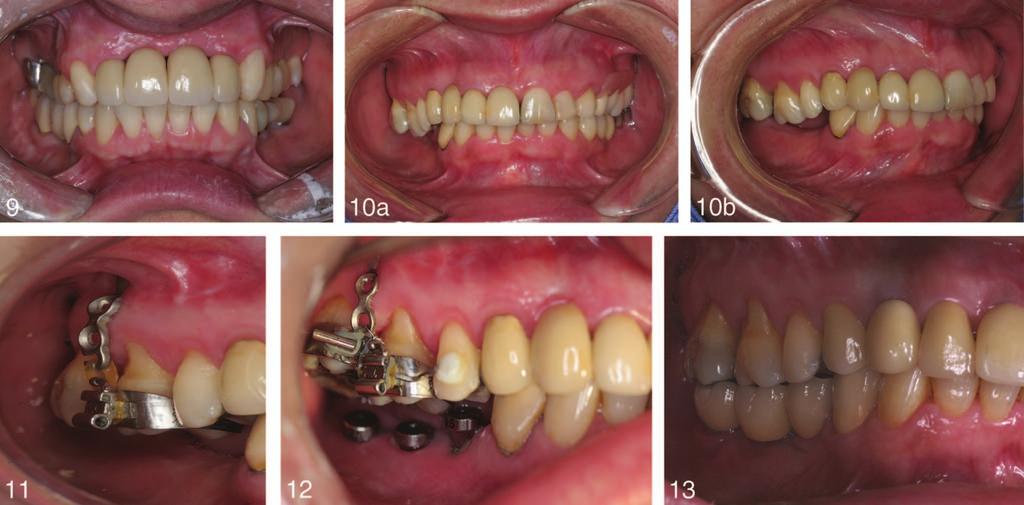 Frontal view of the clinical evaluation. FIGURE 8. Interoclusal space available after the prosthetic abutments selection. FIGURES 9 13. FIGURE 9. Frontal view of the final rehabilitation. FIGURE 10.