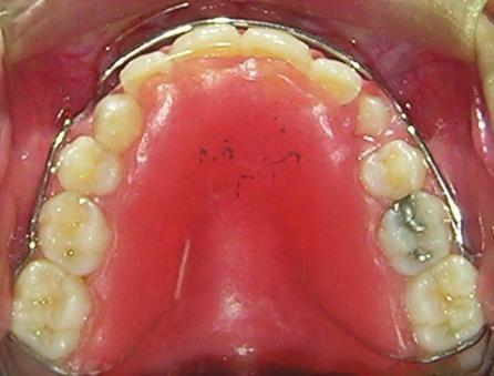 Gradual tightening of loops and simultaneous acryl reduction on the palatal side of anterior teeth permits gradual lingual tipping of anterior teeth.
