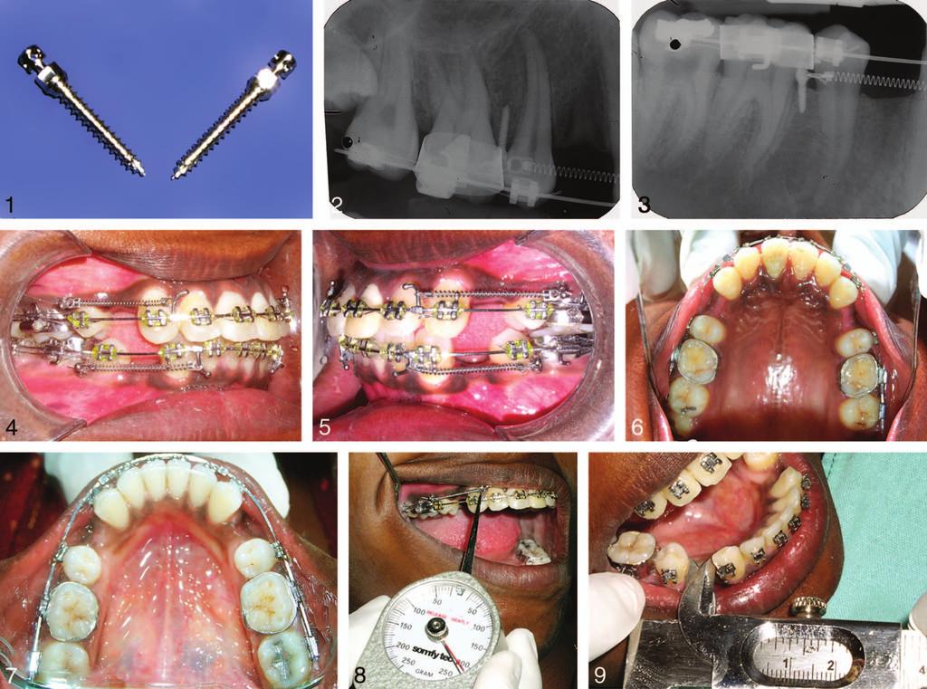 Wahabuddin et al FIGURES 1 9. FIGURE 1. AbsoAnchor micro-implants used in the study. FIGURE 2. Postinsertion intraoral periapical (IOPA) radiograph Maxillary arch. FIGURE 3.