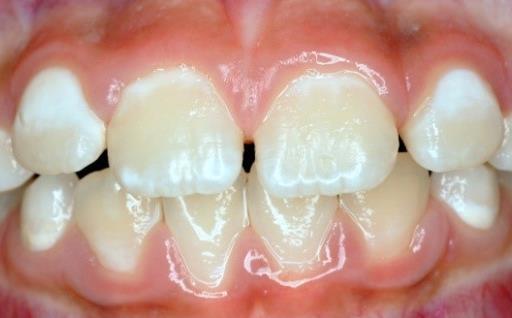 development and eventually to cavitation and caries extending into the dentin (Sundararaj et al., 2015).