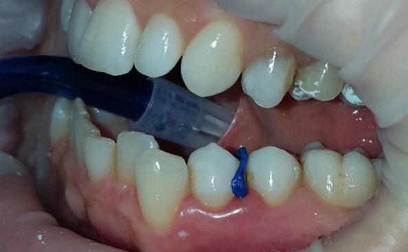 Fig. 8 Gaining adequate interdental space with an orthodontic