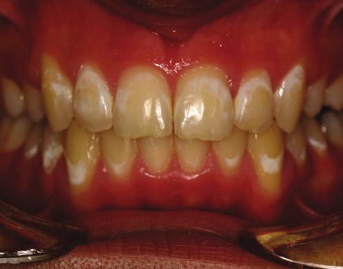 Fig 1. Extensive white spot lesion development during active orthodontic treatment.
