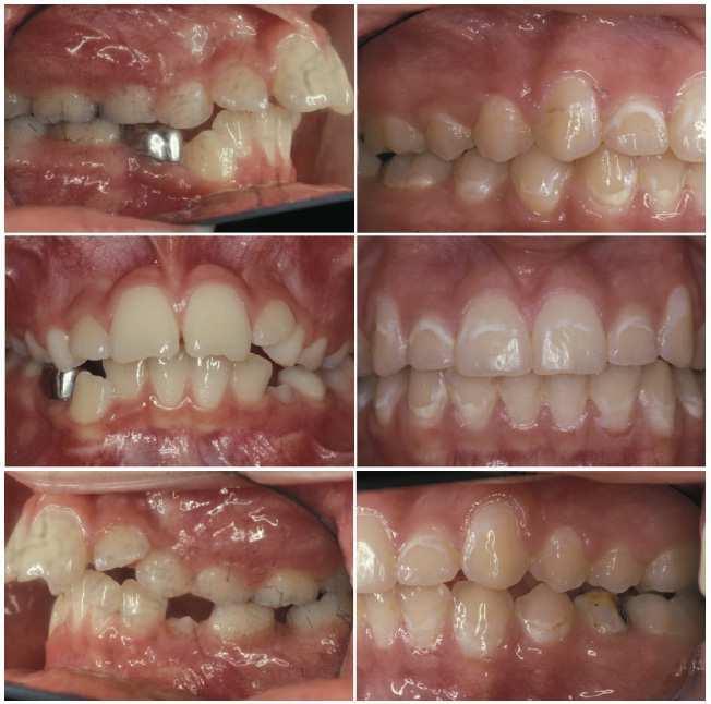 White-Spot Lesions in Orthodontics: Incidence and Prevention 323 Individual slides were scanned into digital format using a Nikon Slide Feeder SF-200 (S) and Super Coolscan 4000 ED scanner.