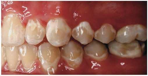 314 Contemporary Approach to Dental Caries 2.