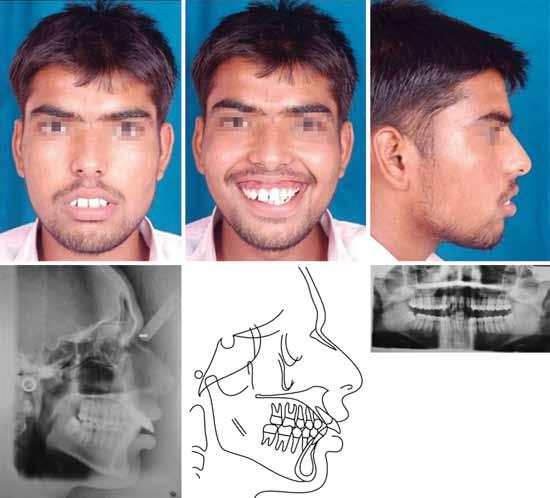 JIOS Surgical-Orthodontic Treatment of Gummy Smile with Vertical Maxillary Excess Fig. 1A: Pretreatment records Fig. 1B: Intraoral pretreatment photographs Cephalometric Surgical Planning (Fig.