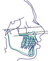 2: Cephalometric surgical planning Step 4: Final profile tracing (red) is done along with soft tissue changes.