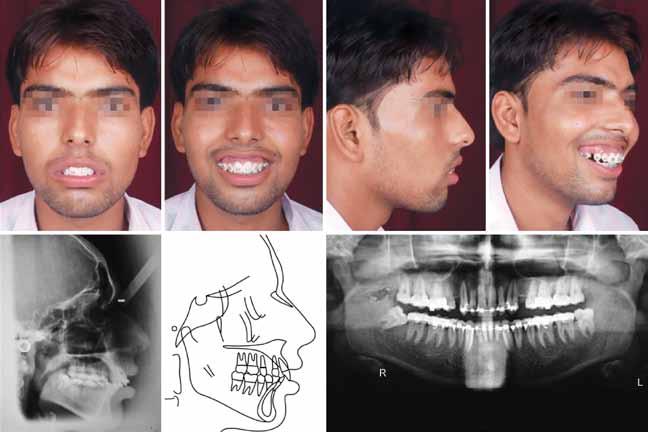 JIOS Surgical-Orthodontic Treatment of Gummy Smile with Vertical Maxillary Excess Fig. 3A: Presurgical records Fig. 3B: Intraoral presurgical photographs in both arches.