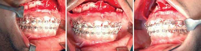 Patient was advised to wear Class II settling elastics to guide mandible into position after autorotation for 4 weeks.