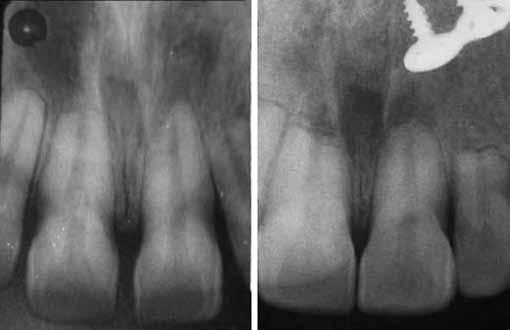 Keeping the significant amount of root resorption in mind (Fig. 6), the postsurgical time for finishing was kept to minimum.