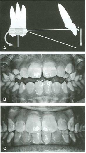 Fig. 8 A. Force system for incisor extrusion, with CTA is inserted into molar brackets upside down. Vertical forces shown are ideal for correction of minor open bites. B.
