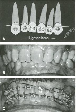 Fig. 9 A. Force system for correction of anterior cant of occlusal plane, using asymmetrical ligation of CTA. B. Patient with anterior occlusal cant before treatment. C. CTA using mechanics shown in A.
