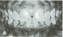 To prevent opening of spaces in Class II molar patients, premolars are tied to molars. D. Patient after treatment, showing overbite correction and Class I buccal occlusion. E.