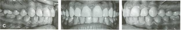 Upper-lip-to-upper-incisor relationship was ideal; therefore, mandibular incisor intrusion was required. B.