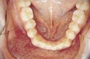 central mandibular incisor and marked mesiodistal stripping