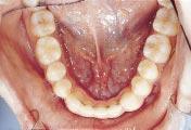 evaluate possible mesial movement of the mandibular molars