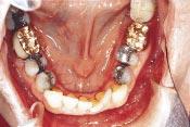 extraction of one mandibular incisor and associated
