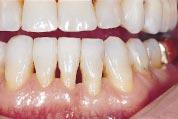 mandibular incisors and continued orthodontic space